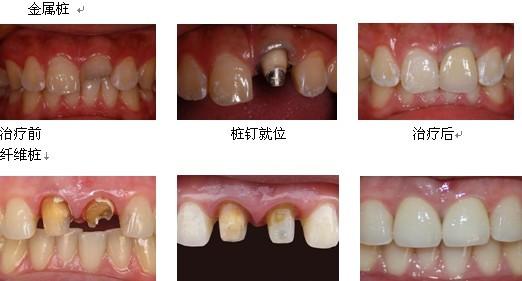 口腔牙体修复中桩冠和桩核冠的区别