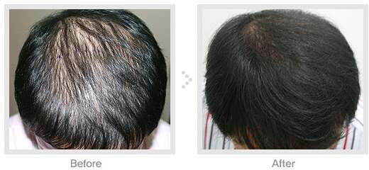 女性雄脱导致的发量稀少的解决方案?米诺or植发?