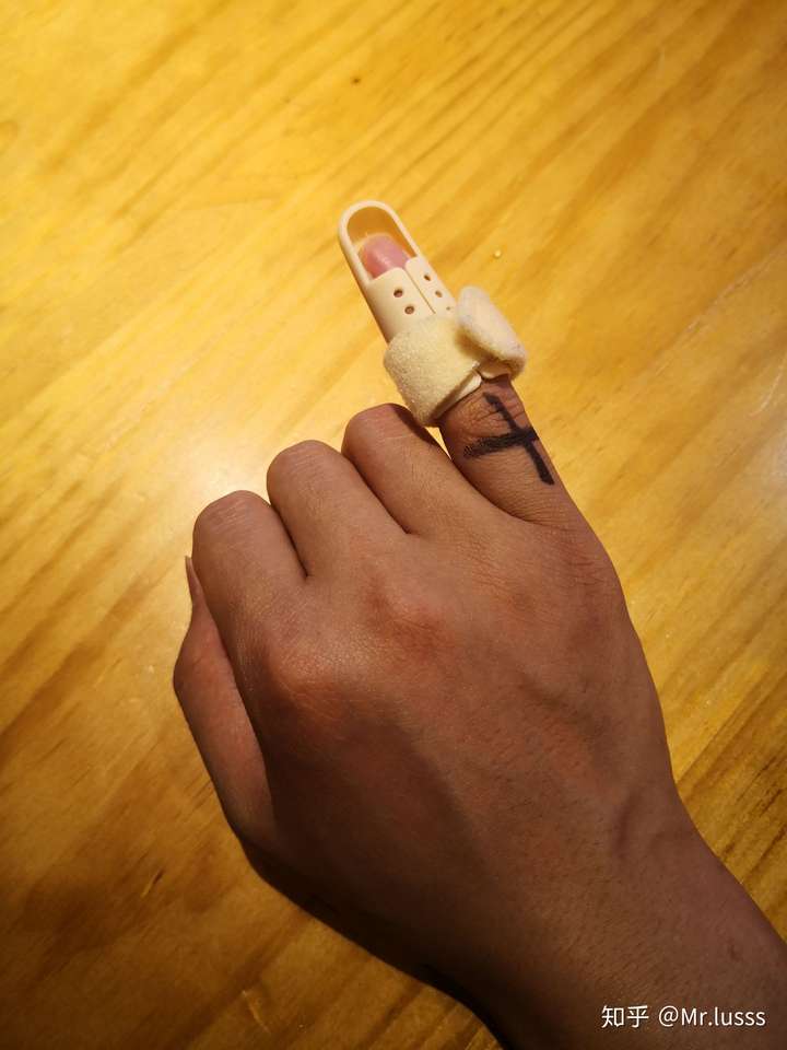 打篮球时手指戳伤不能伸直,求有经验的大神告诉我这是否严重啊!