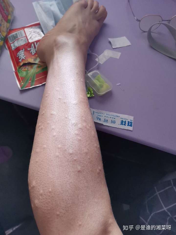 夏天太热起鸡皮疙瘩痒痒(天热身上起鸡皮疙瘩很痒怎么回事)
