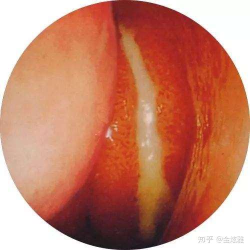 我得了鼻炎还是鼻窦炎?