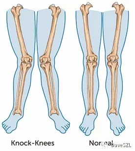 x型腿膝外翻造成的原因簡單的預防與矯正