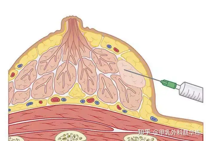 Breast Tissue Diagram