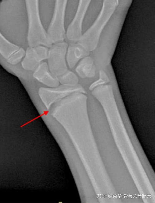 生长板骨折 损伤 Growth Plate Physeal Fractures 知乎