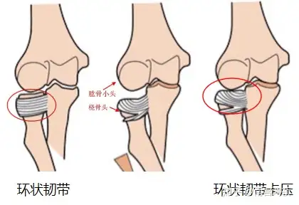 呈椭圆状,偏外后侧较平桡骨头半脱位的原因02桡骨头半脱位:肘关节受到