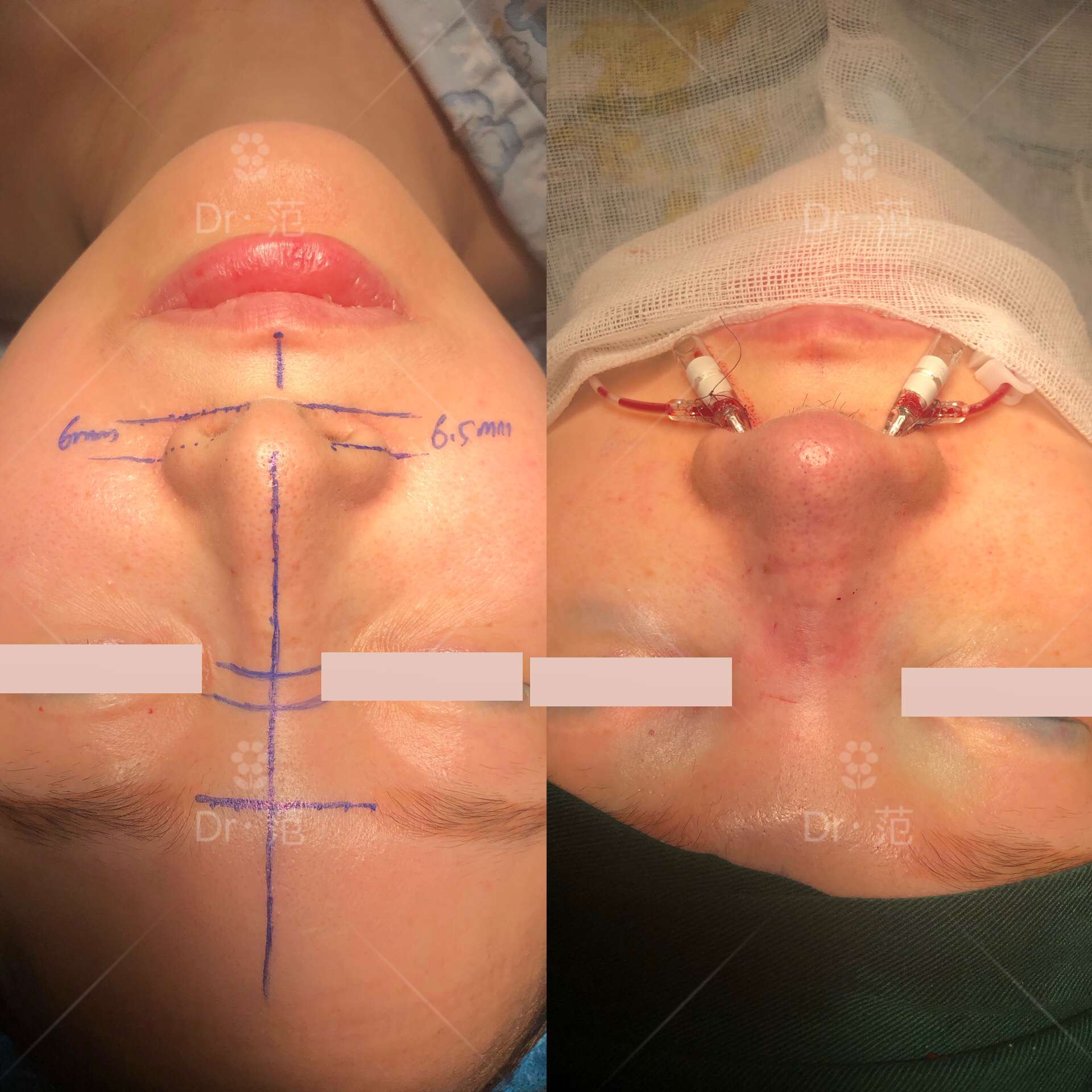 整形美容范锴医生 的想法: 鼻翼缘退缩矫正 | 无论哪种原因造成的退