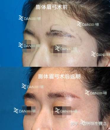 垫眉弓 眉骨增高 用什么材料效果最为理想 知乎