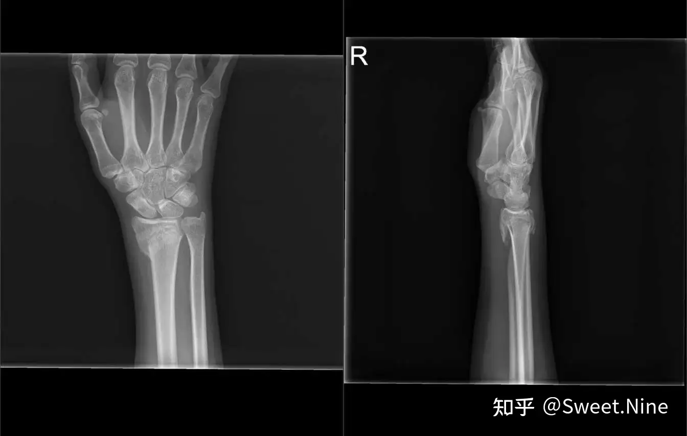 右手桡骨远端骨折 知乎 右手桡骨远端骨折 知乎