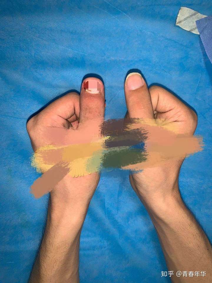 为什么我的大拇指短而宽?