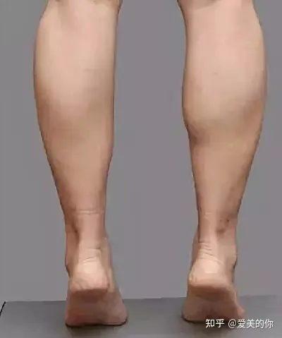 大腿脂肪萎缩图片图片