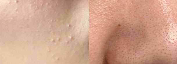 闭口型，左边粉刺，右边黑头