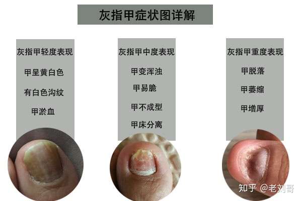 怎么判断是不是灰指甲