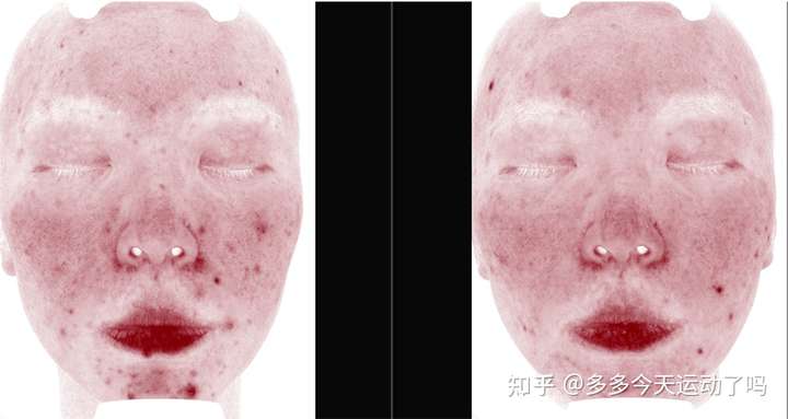 医生说我的皮肤有了慢性炎症炎症，怎么办？（用美塑抗炎疗法改变visia红！）
