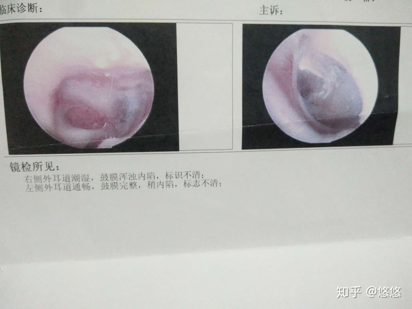 慢性 化脓性中耳炎 鼓膜大穿孔一年自愈经历 知乎