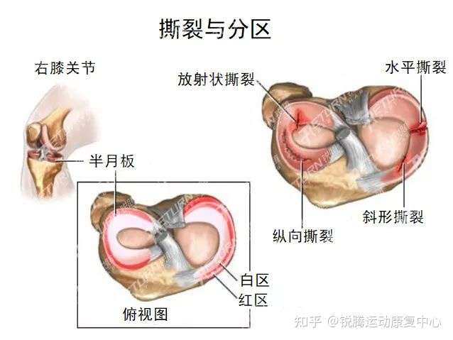 半月板损伤 我该拿什么拯救你 知乎