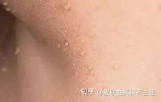 丝状疣也会传染