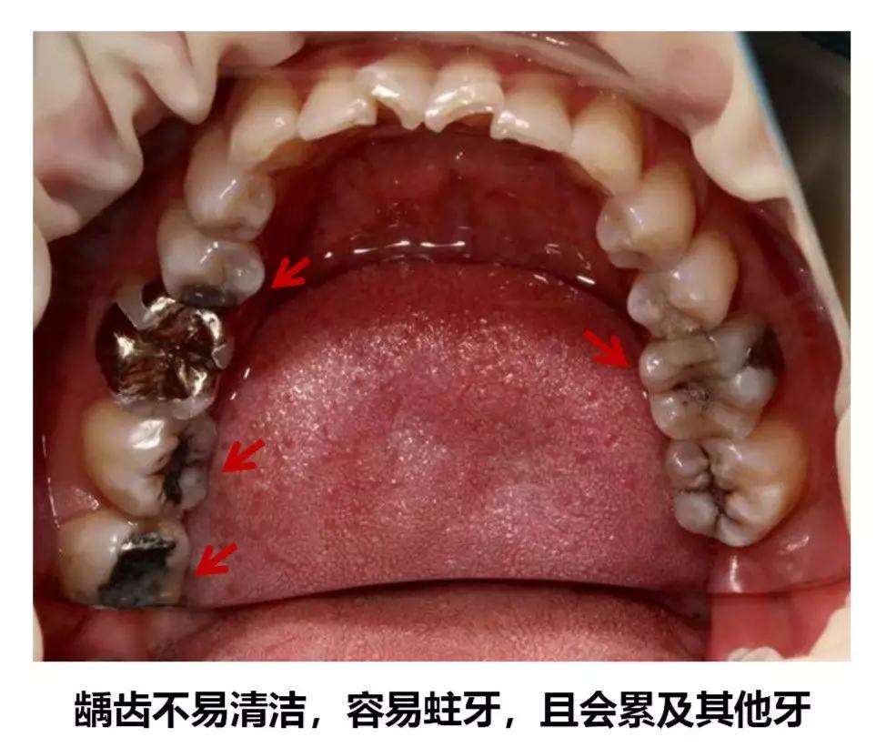 某明星拔完智齿 脸竟变成了这样 到底该不该拔 今天和你说清楚 知乎