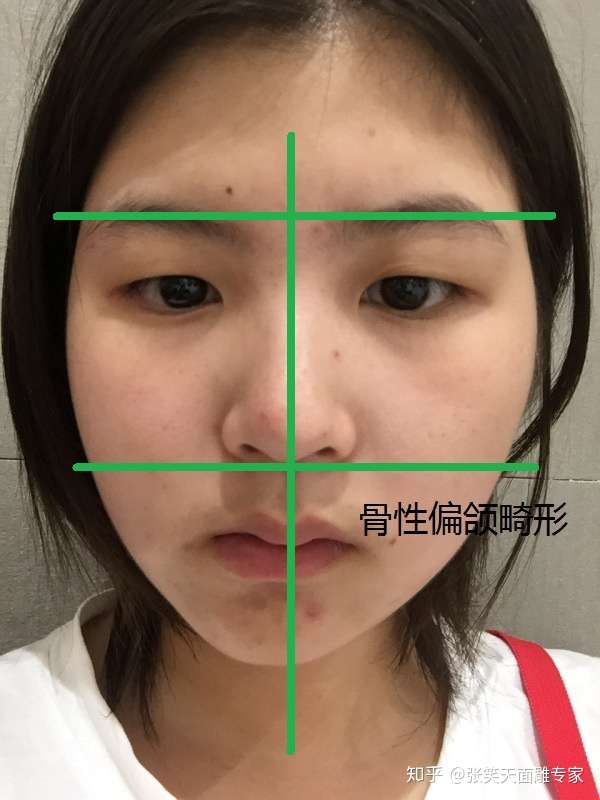 面部骨骼不对称