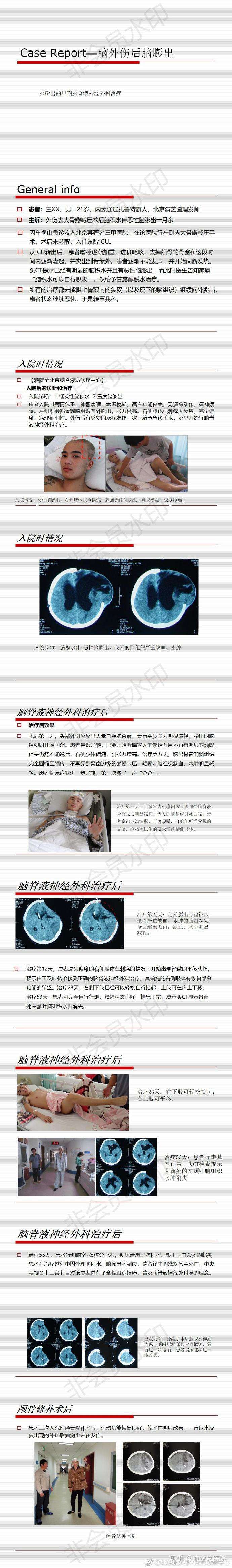 脑外伤后脑积水的 教科书陷阱 论外伤后脑积水的正确打开方式 知乎