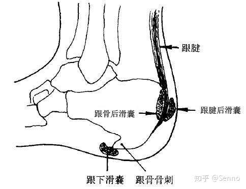 跟骨后滑囊炎的治疗 知乎