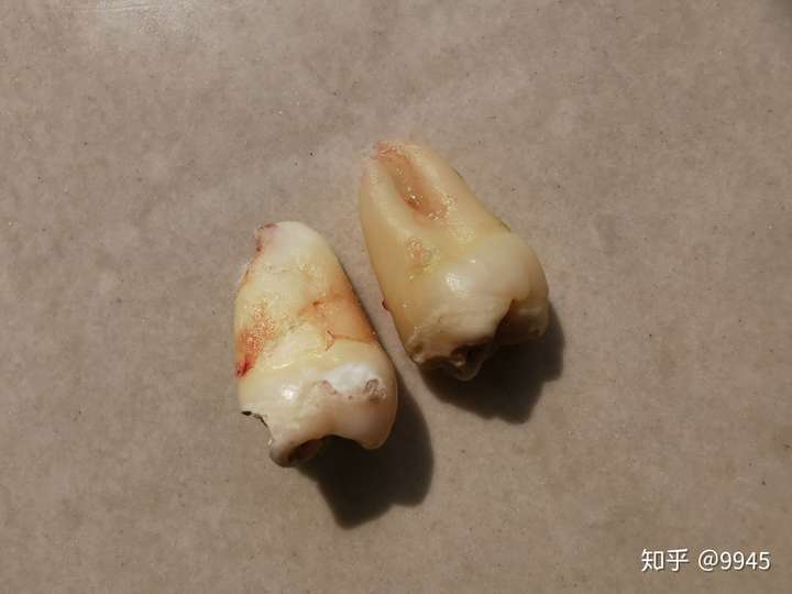 拔完智齒可以把牙要回來嗎