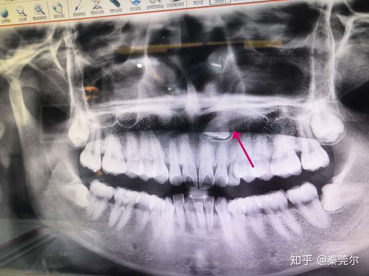 这样的上颌埋伏牙,拔出难度大吗?风险呢?