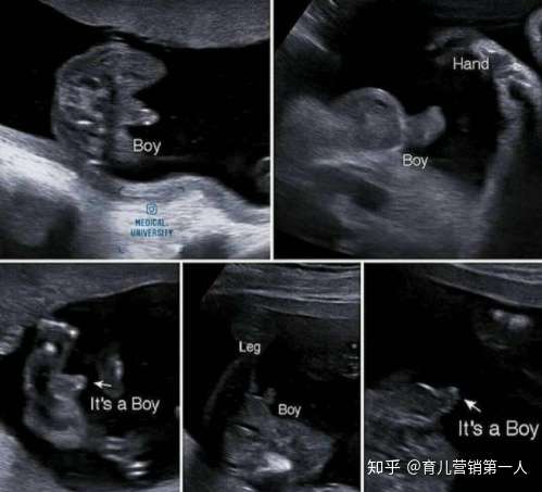 鉴定胎儿性别 大多数夫妻都想错了 别再被误导了 知乎