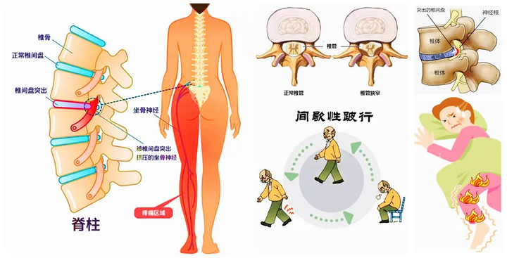 
编辑切换为居中
添加图片注释,不超过 140 字(可选)
腰间盘突出的症状有哪些症状,腰间盘突出的五大症状插图5