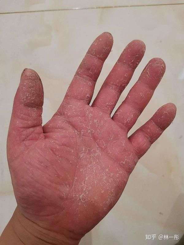 手上蜕皮怎么回事看图片求原因和治疗方案