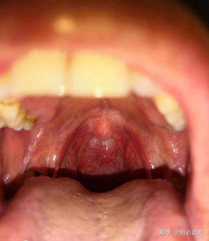 正常喉咙咽后壁图片图片