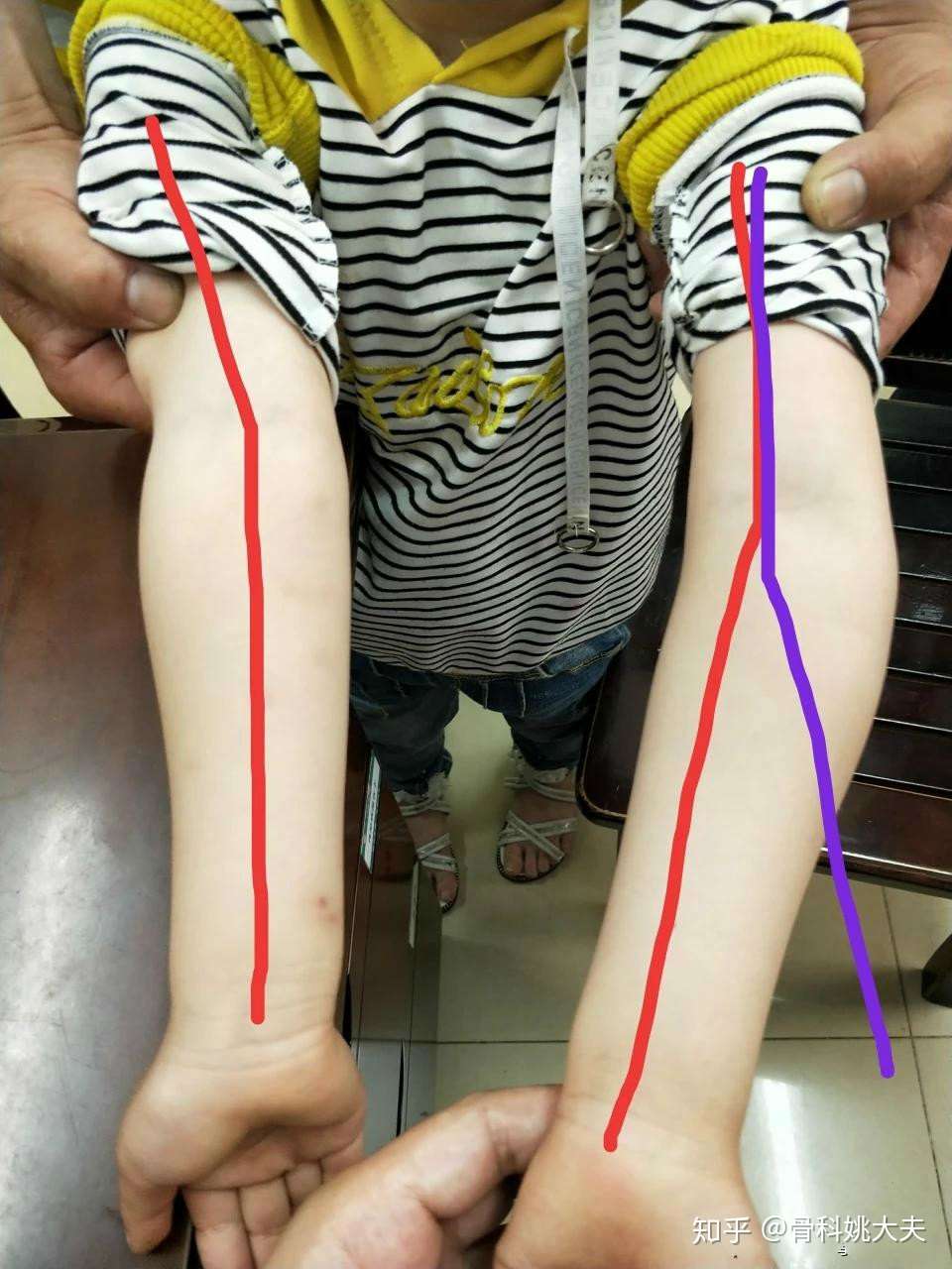 家长讳疾忌医导致孩子手臂畸形 现在后悔莫及 知乎 家长讳疾忌医导致孩子手臂畸形 现在后悔莫及 知乎