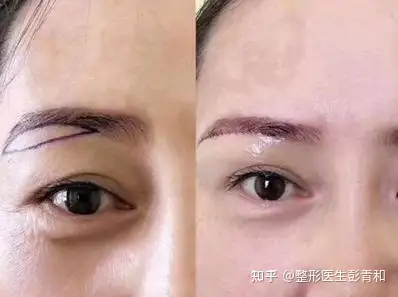 做双眼皮时上睑松弛和上睑下垂中的区别大家都知道吗