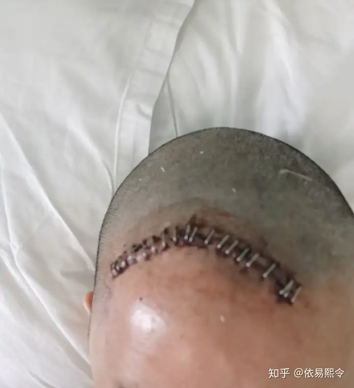 额部骨瘤手术全过程记录~中山大学附属第一医院（四）～附伤口照片丨额骨骨瘤手术大概多少钱