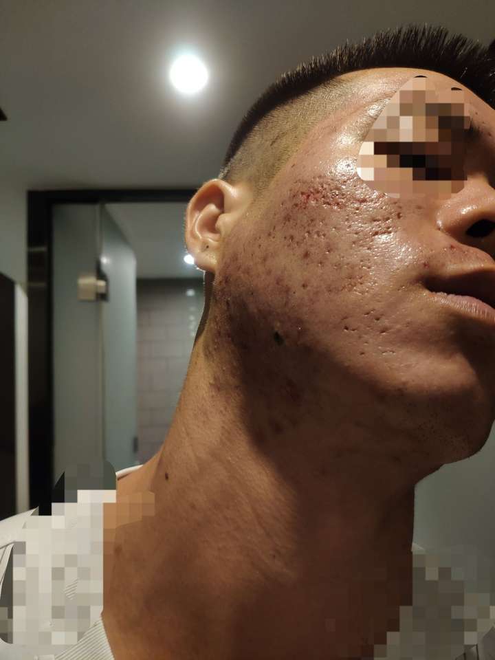 去痘印痘坑经历