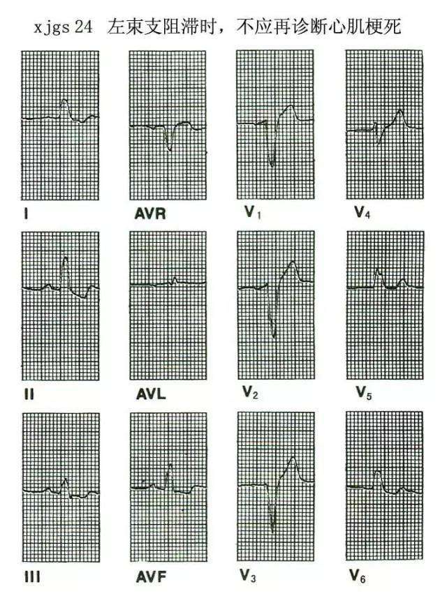 常见的心脏传导阻滞心电图 全在这里了 看到就是赚到 知乎