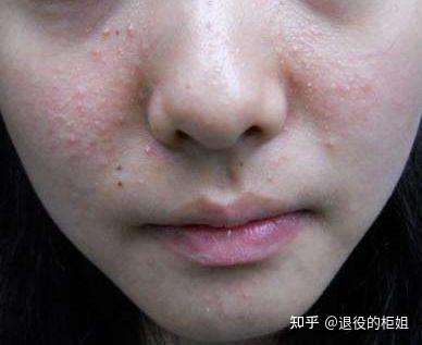 脸颊两侧闭口好几年了 怎么办呢?哭了 ?