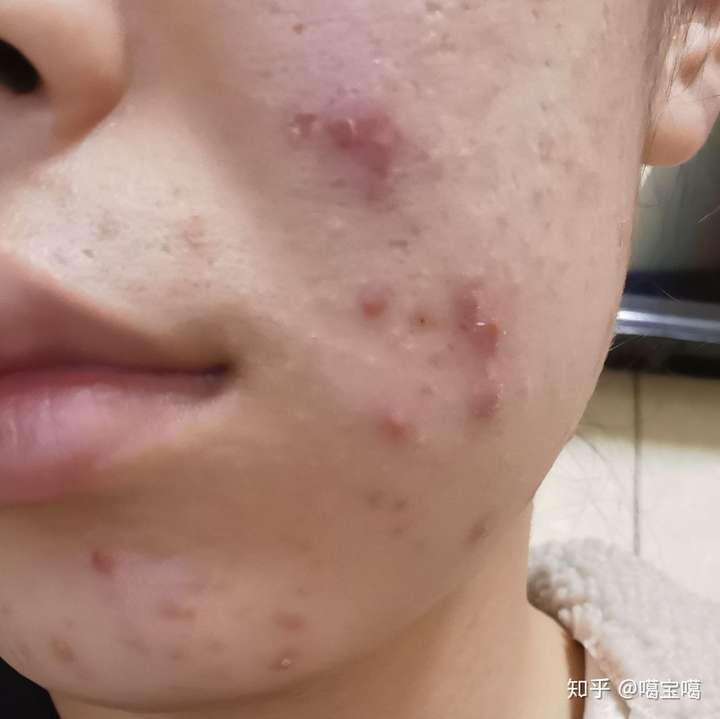 本人实习生昨天去美容院说我痘痘情况很严重给我开了一个两个月3800的