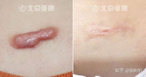 手术后的疤痕增生