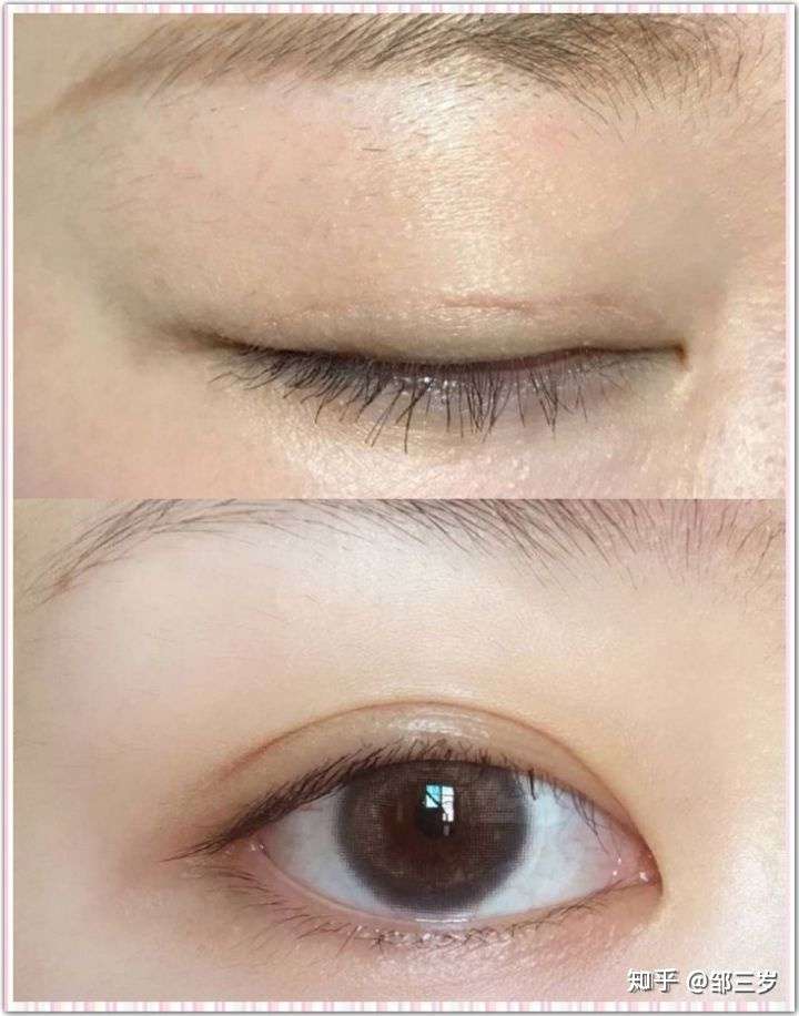 上海开扇双眼皮案例