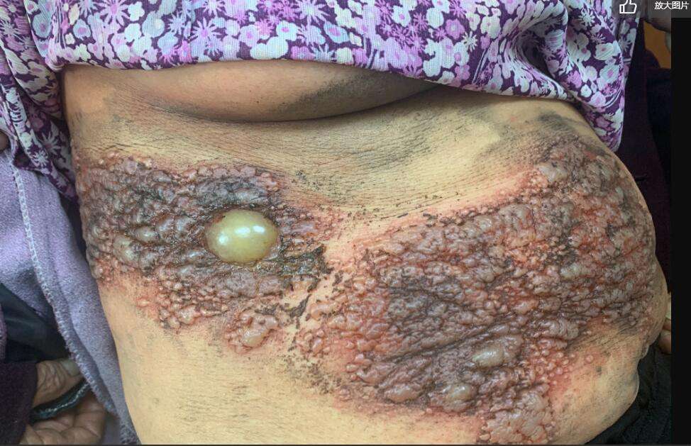 皮肤医生李志忠 的想法: 为什么说治疗带状疱疹后遗神经痛应注重神