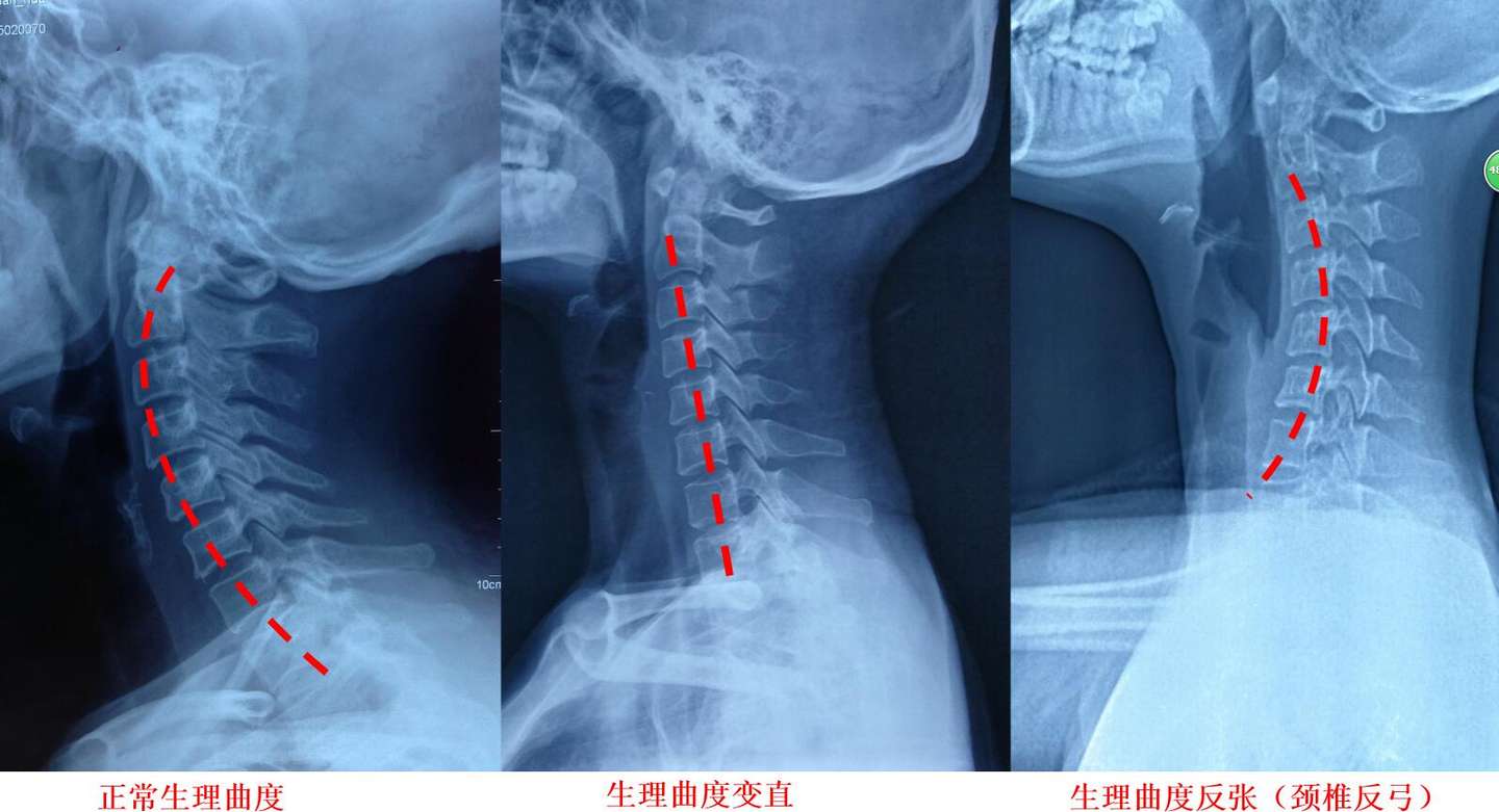 颈椎反弓 是什么鬼 知乎