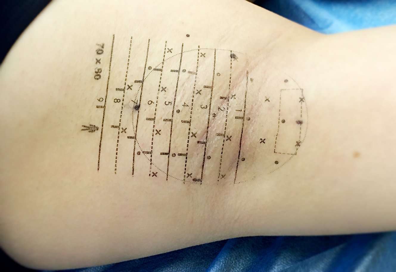 王永春 的想法: #腋爽治疗中心# q:腋汗微波治疗前,医生… - 知乎