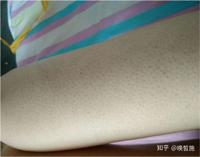 鸡皮肤补维生素什么(鸡皮肤要补充什么维生素)