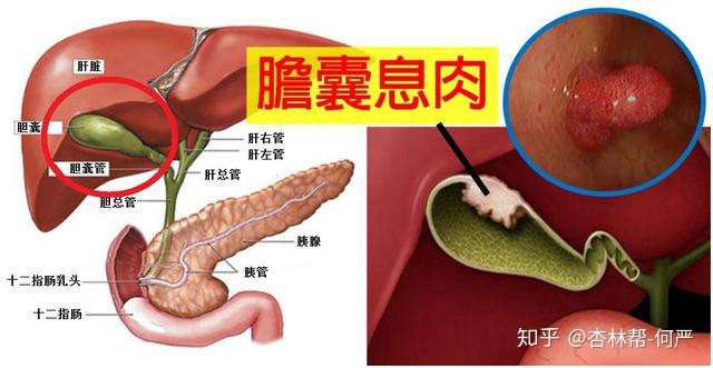 什么是胆囊息肉 胆囊息肉需要手术治疗吗 知乎