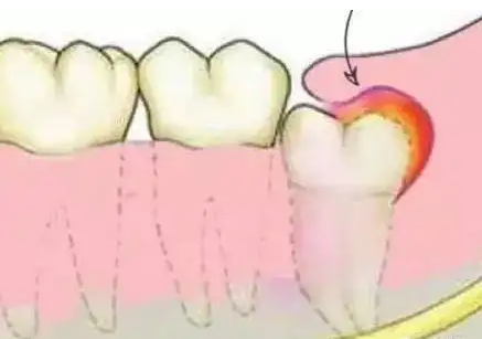 牙痛是什么原因引起的？