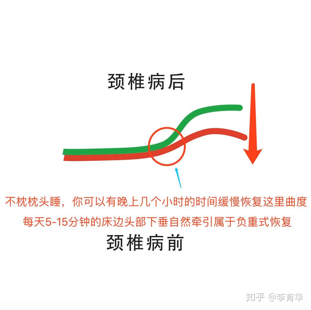 我的颈椎病治疗探索 微信群图文实录 知乎