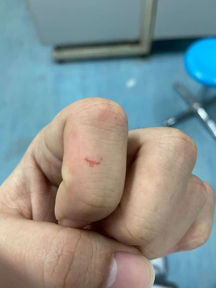 我被实验小鼠咬了一口,流了不少血,需要打疫苗吗?