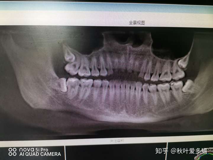 為什麼90後普遍要拔智齒