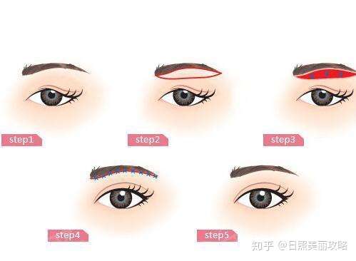 什么情况下需要做眉弓呢眉弓的材料如何选择以及恢复期又是多久 知乎