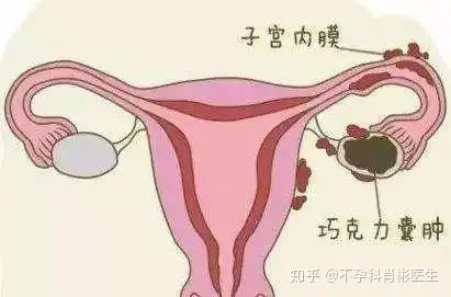 女性工作長期久坐很容易導致女性的盆腔充血,導致附件和宮頸的血液